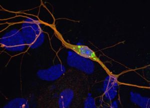 La maladie à corps de Lewy - Fondation pour la Recherche sur le Cerveau