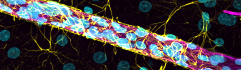 Sclrose en plaques : comment les cellules immunitaires atteignent-elles  les neurones pour causer la maladie ? - Fondation pour la Recherche sur le  Cerveau