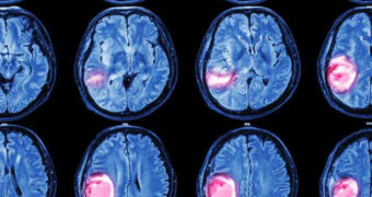 Tumeur cérébrale Archives - Fédération pour la Recherche sur le ...